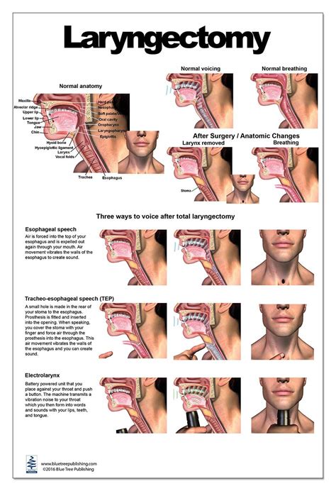 Laryngectomy Anatomy