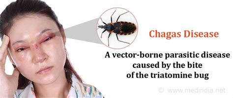 Chagas Disease