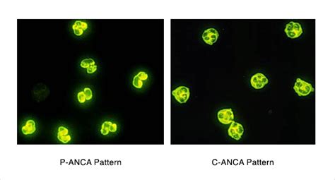 p anca vs c anca – anticorps anticytoplasme des polynucléaires ...