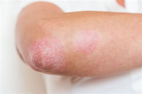 Dimethyl Fumarate Regulates Treg–Th17 Axis in Psoriasis - Dermatology Advisor