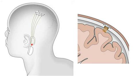 Elon Musk Presents Neuralink, A Revolutionary Brain Implant