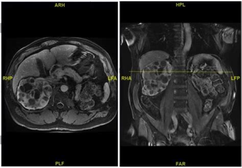 MRI abdomen with and without contrast. Caption: MRI abdomen with and ...