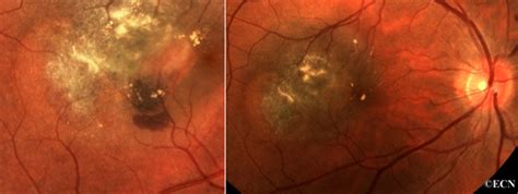 Choroidal Tumors Image Gallery » New York Eye Cancer Center