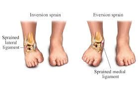 Torn Deltoid Ligament