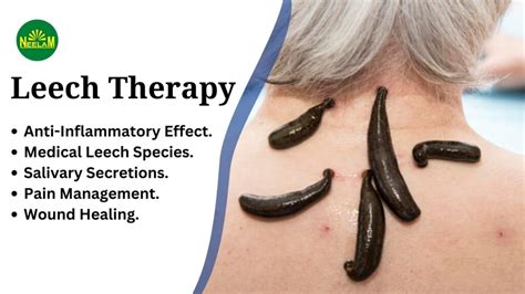 Leech Therapy - Neelamdawakhana.com