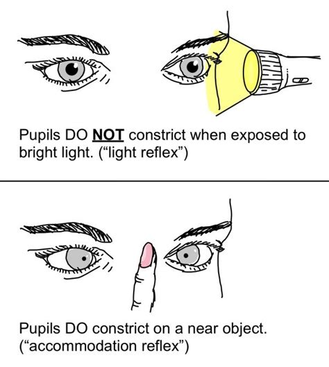 Light Reflex Pathway And Defects | Medical Junction