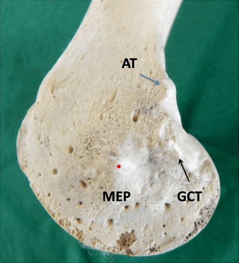 Adductor Tubercle Palpation