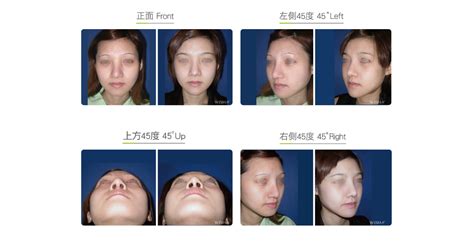 Zygomatic Arch Reduction-Facial Bone - Before&After | WishClinic