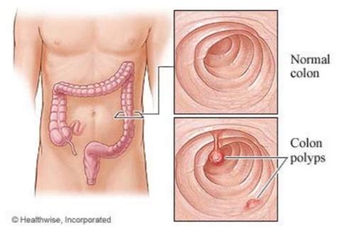 Colon Polyps: After Your Visit | South Denver GI