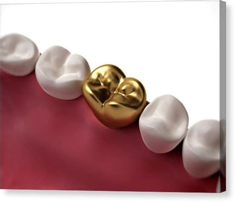 When Is Gold Used in Dentistry? - Your Dental Health Resource