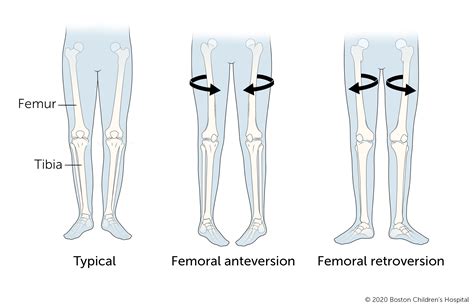 Walking (Gait) Abnormalities | Boston Children's Hospital