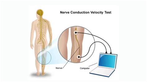 Why Might You Need a Nerve Conduction Test?