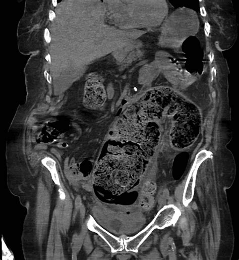 A fatal faecaloma stercoral colitis: a rare complication of chronic ...