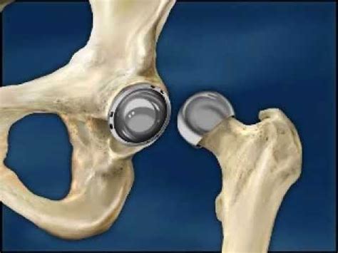 Hip Resurfacing Surgery Dr Bert Thomas Los Angeles - YouTube