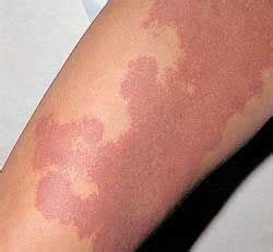 Port wine stain on the leg | Port wine stain, Port wine stain birthmark, Birthmark