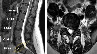 Herniated Disc Mri L5 S1 - Lumbar Herniated Disc - A More in Depth Look ...