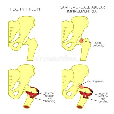 Hip Joint Problem_Cam Femoroacetabular Impingement Stock Vector ...