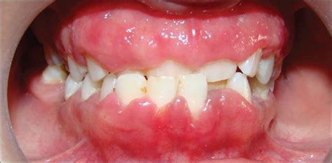 Swollen Gums | Med-Health.net