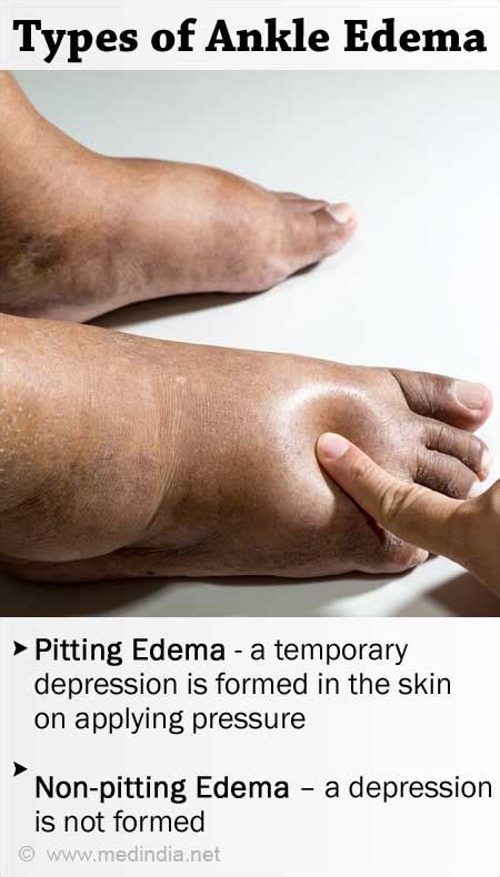 Pitting Edema VS Non-Pitting Edema: What's The Difference?, 60% OFF