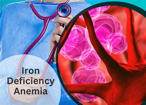 Iron Deficiency Anemia Symptoms