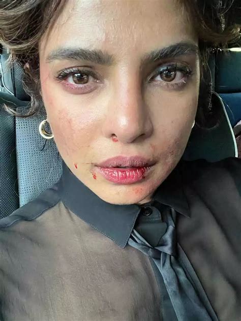 Priyanka Chopra Jonas shares a photo of her bruised face from the set ...