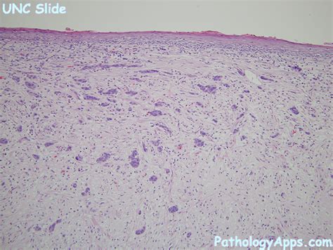 adenocarcinoma esophagus histology