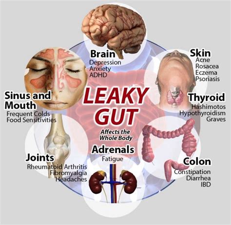 Leaky Gut Symptoms and Treatment | Sydney GP