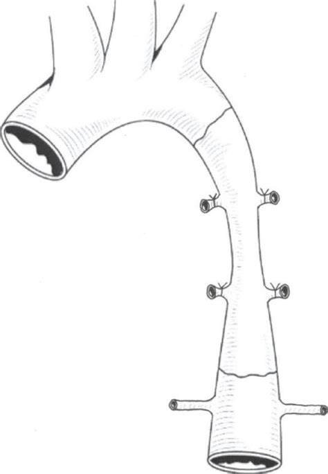 Resection and end-to-end anastomosis. | Download Scientific Diagram