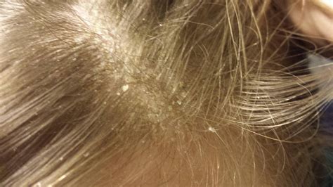 Help! My dandruff is insanely bad, and I don't want to use shampoo if I ...