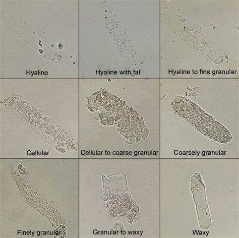 Medical Laboratory and Biomedical Science: Urinary casts