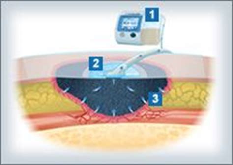 NPWT | KCI Wound Vac Wound Care, Healing Process, Wounds, Physical ...