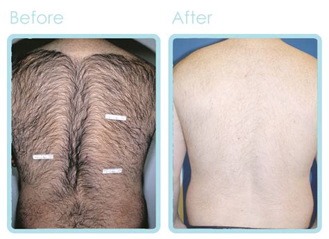 Laser Hair Removal After Hair Transplant Cheap Sale ...