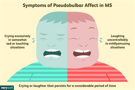 Un aperçu de l'affect pseudobulbaire dans la SEP - Fmedic