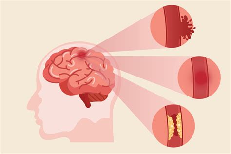 Thunderclap Headache: Why Many Call it The “Worst Headache Ever”