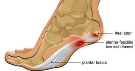 Heel Spurs Treatment | Plantar Fasciitis - Heel Pain | Cottesloe, Perth