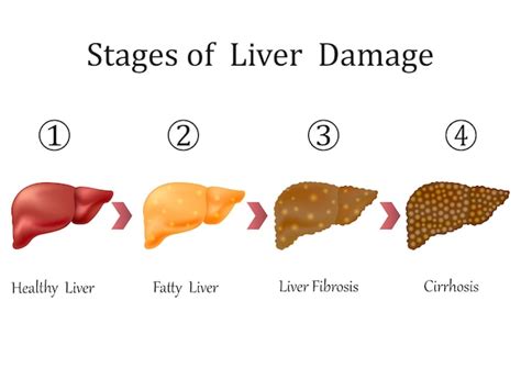 Premium Vector | Stages of liver disease leading to cirrhosis