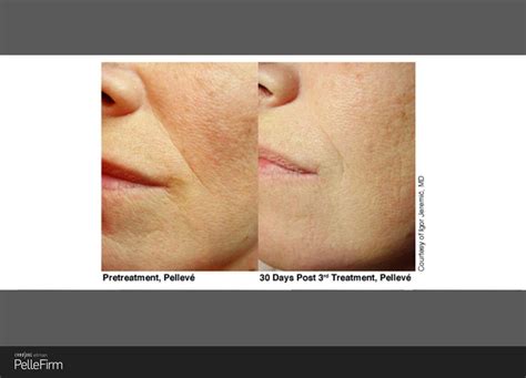 Pellevé™ Wrinkle Reduction • Pure Rejuvenation Anti Aging & Laser Clinic • Toronto