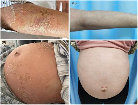 Generalized pustular psoriasis (GPP) of pregnancy before and after ...