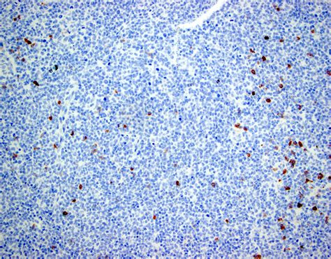 Follicular Lymphoma Pathology Outlines