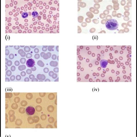 (i) image showing nucleated cells(NRBC,circled in red and WBC circled... | Download High ...