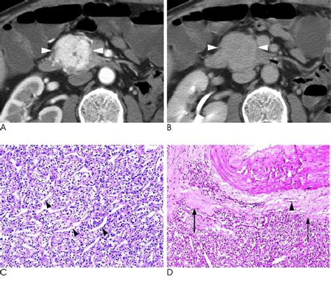 A 70-year-old man with a nonfunctioning islet cell tumor that was found ...