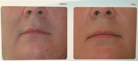 Before and After Laser Hair Removal Pictures | CanovaMedical.com