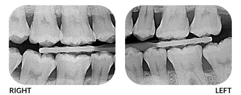 Why Do I Need X-Rays When I Visit the Dentist? - Twinkle