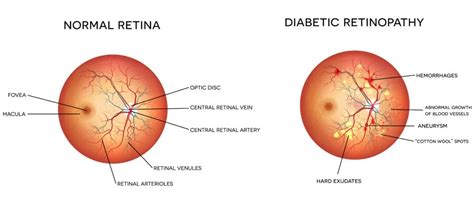 Diabetic Retinopathy Cincinnati | Diabetic Eye Care Cincinnati, OH