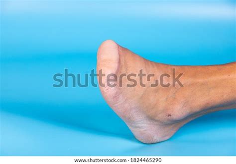 3,576 Amputation Foot Images, Stock Photos, 3D objects, & Vectors ...