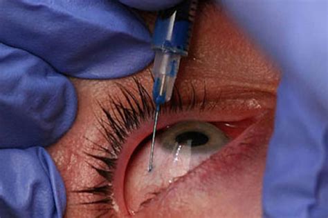 Controversy: confusion reins over eye injection guidelines - Insight