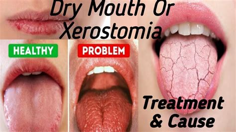 Dry mouth or Xerostomia (Cause & Treatment) - YouTube