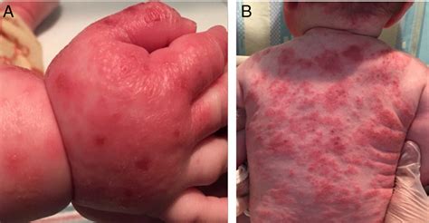 Figure 4 from Enterovirus Infections. - Semantic Scholar