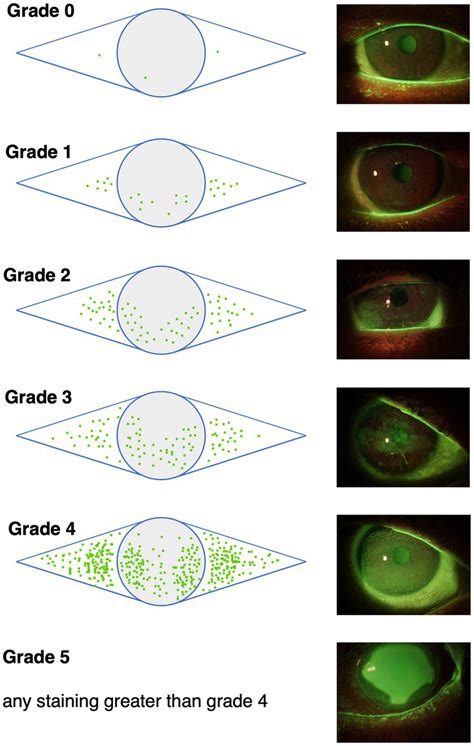 The Oxford grading scheme differentiates 5 grades of corneal and... | Download Scientific Diagram