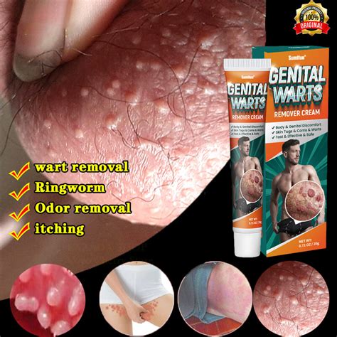 Private Wart Remover Cream Ointment Private Parts Care Flat Warts ...